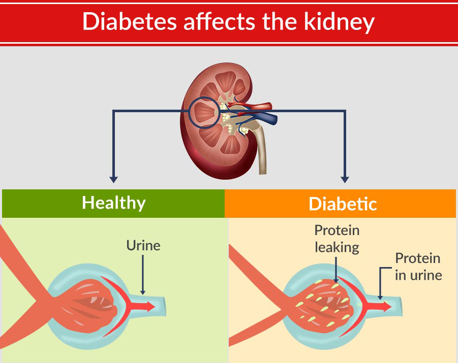 diabetes-kidney-failure-treatment